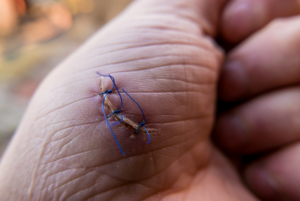 Cutting injury at work claims