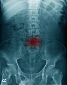 spinal injury from an accident at work