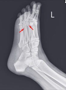 broken foot at work